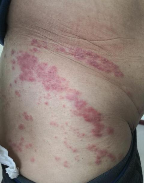 pem临床症状